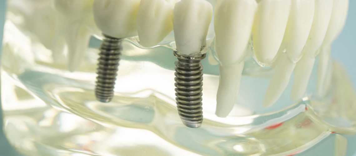2 single dental implants with crowns on top placed into the clear jaw model
