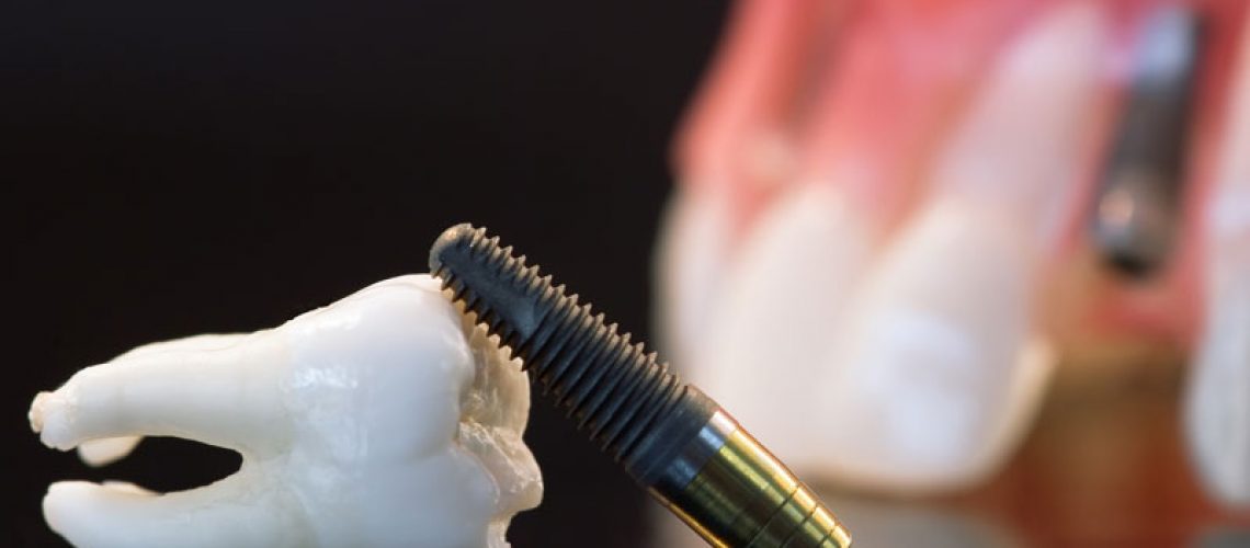 The image shows a dental implant next to a model of a human tooth or jawbone, commonly used in dental offices to demonstrate the function and placement of dental implants.