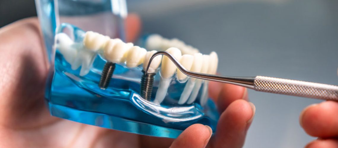 close-up of a dental implant model being held by a hand. The model shows a clear plastic jaw with a set of white teeth. One of the teeth has a metal dental implant installed in it, and a tool, likely a dental explorer or probe, is being used to point at or manipulate the implant.