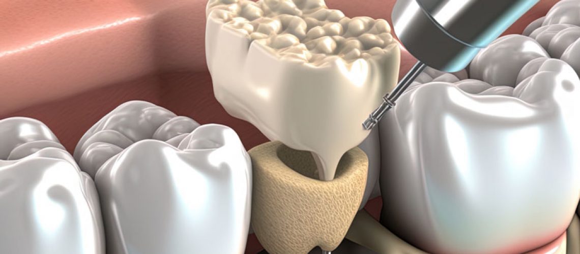 model of a bone grafting and dental implant procedure.