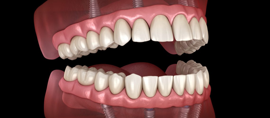 a 3D image of a all-on-4 dental implants model in Ocala, FL.