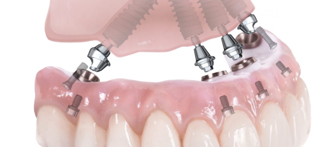 An image of dental implants.