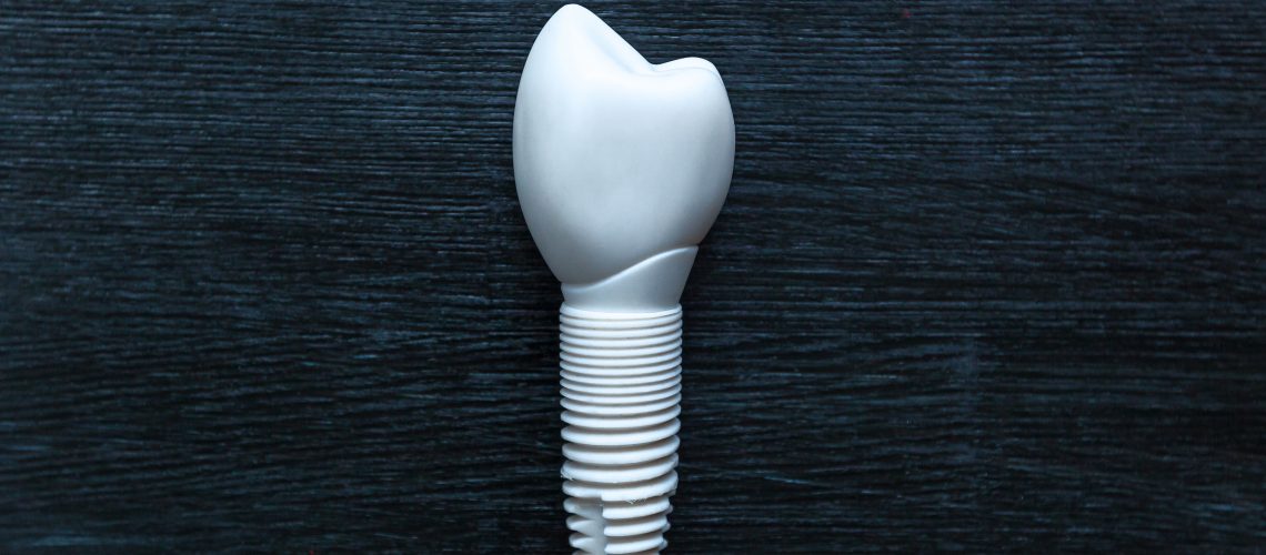 dental implants gainesville fl