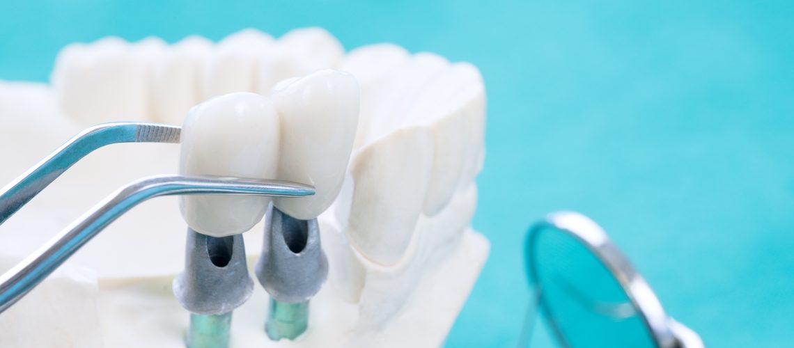 dental implants the villages fl