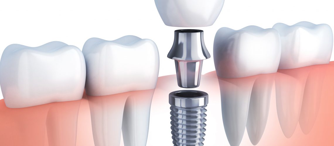 dental implants gainesville fl