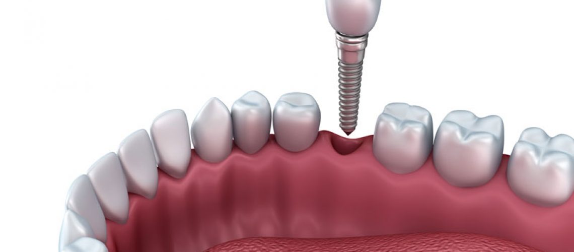 Dental Implant Model