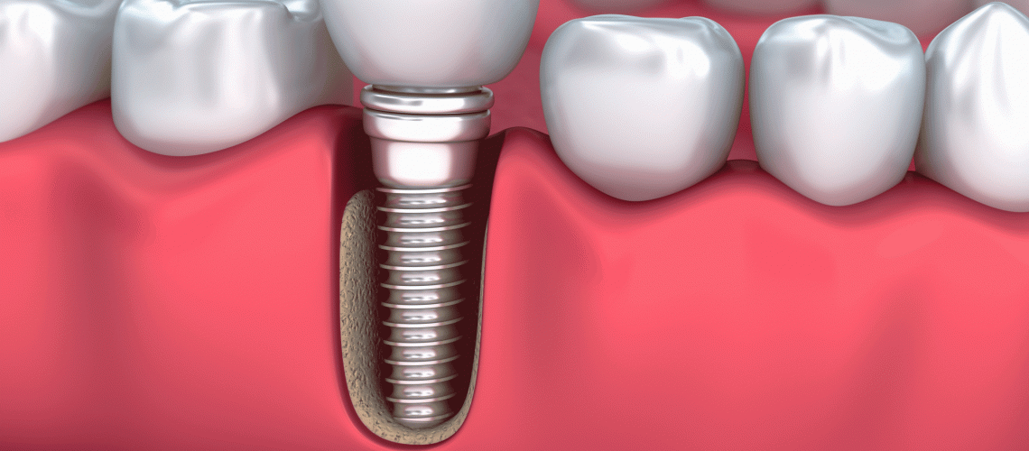 Medically accurate 3D illustration of a Dental Implant