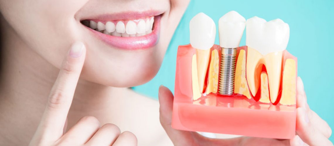 Dental Patient Holding Up A Dental Implant Model