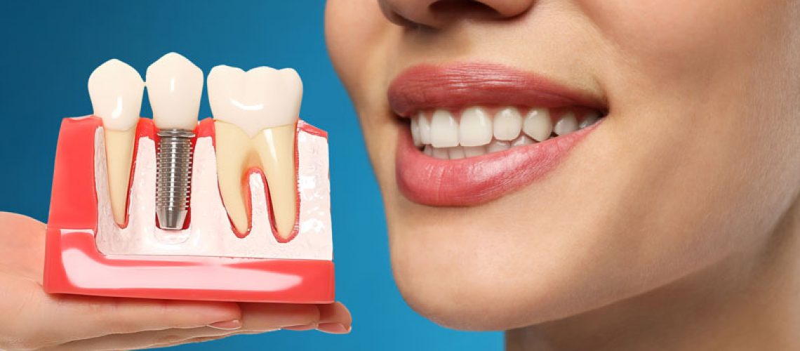 The image shows a woman holding a dental implant model, illustrating the implant post and crown. Her bright smile highlights the benefits of dental implants for a natural, restored look. The background contrasts the model, emphasizing the implant's features and the aesthetic improvement.