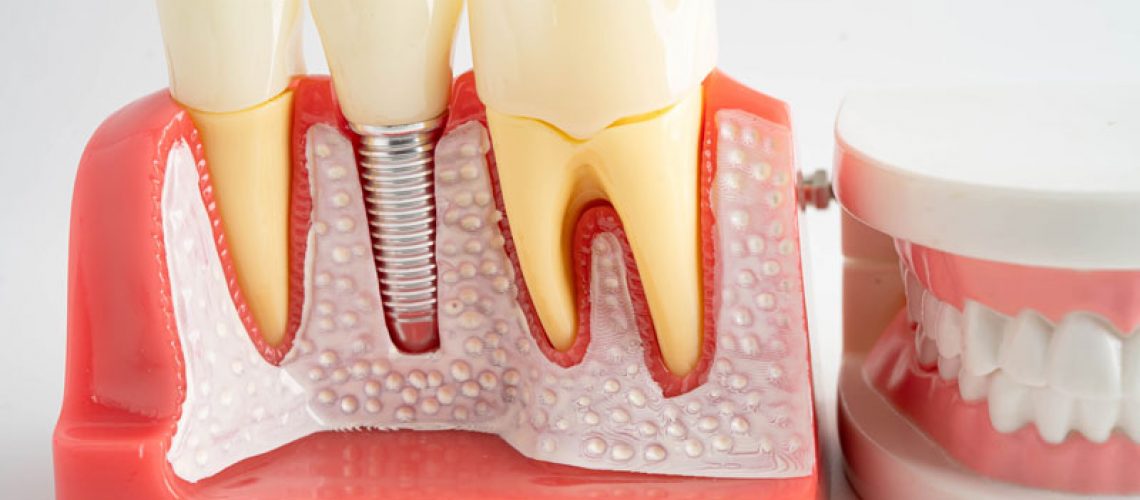 a dental implant model with a full arch sitting next to it