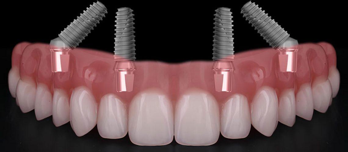 all on 4 dental implants with a full arch going across it