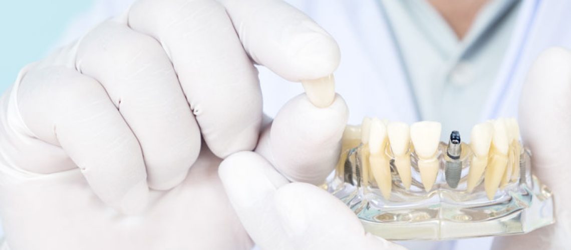 an implant dentist holding a dental implant crown and model.