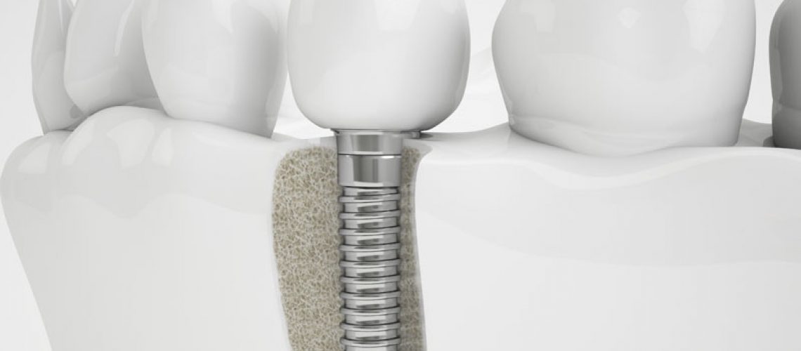 a dental implant that has been surgically placed in the area of the jawbone where a bone grafting procedure was performed. The dental implant is surrounded by natural teeth.