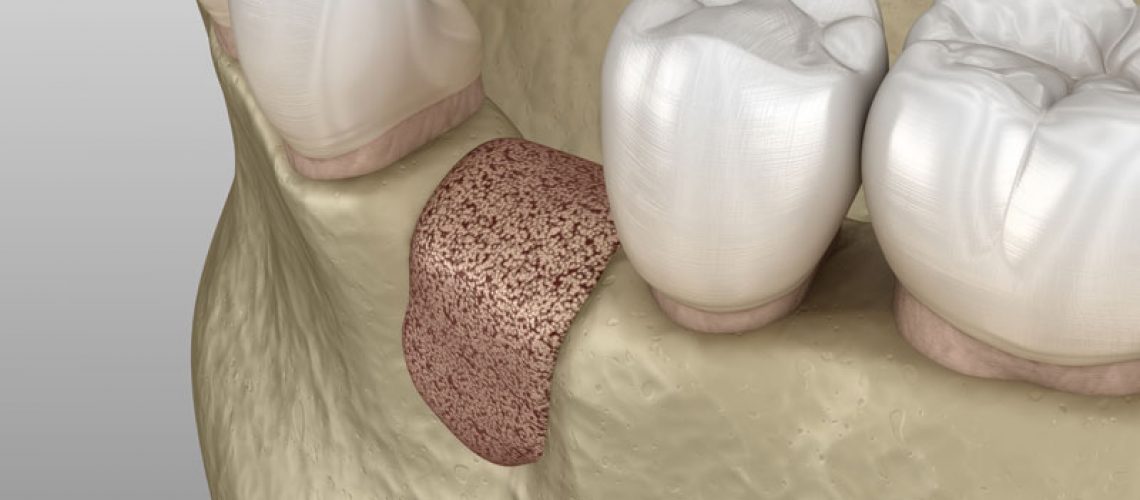 Bone Graft Where A Tooth Is Missing