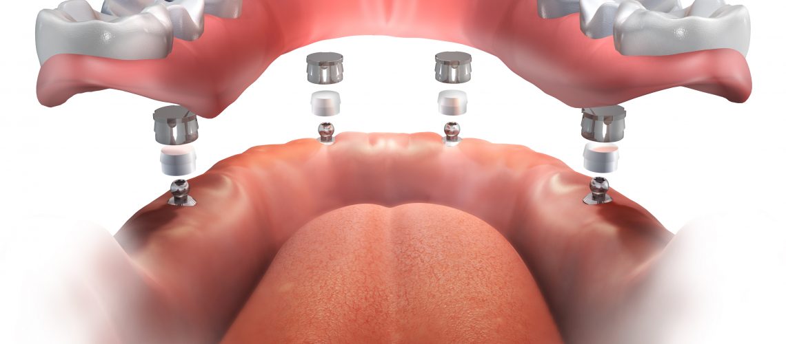 all on 4 dental implants gainesville fl