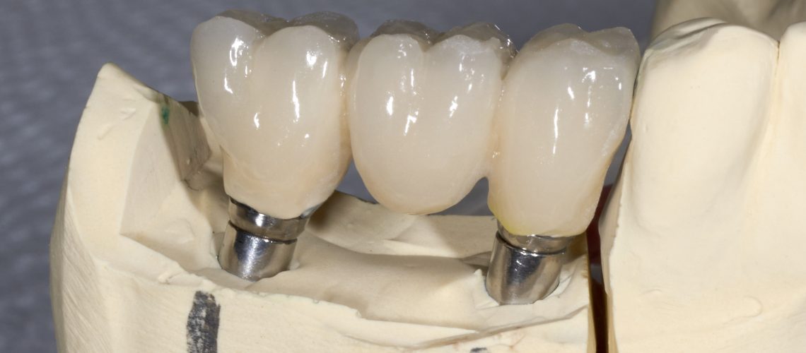 dental implant cost the villages fl