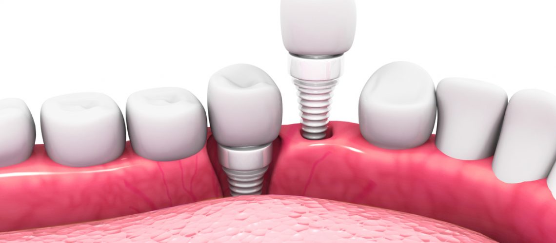ceremicdentalimplant