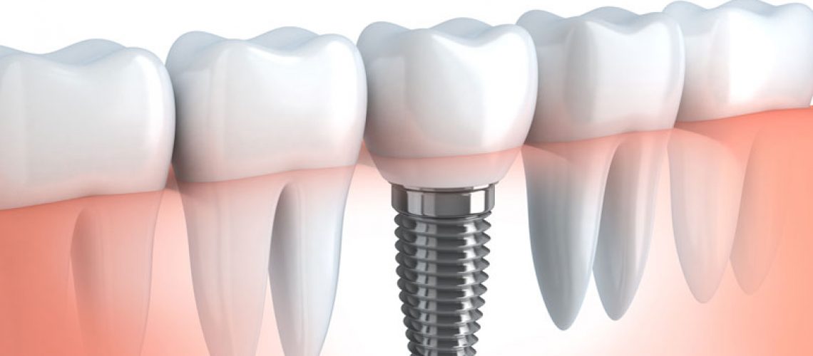 an image of a dental implant, with the dental implant post placed in a transparent gum line, surrounded by natural teeth.