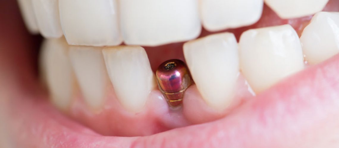 Dental Implant Post Showing In A Patient's Lower Jaw