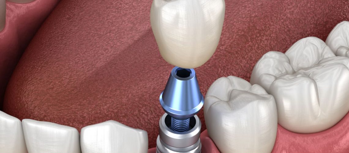 Dental Implant Model