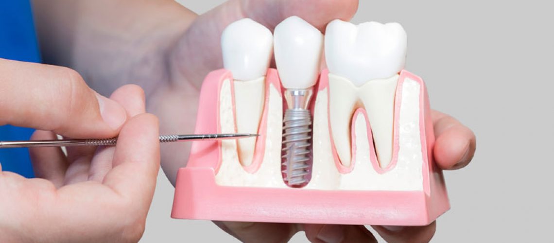 Dental Implant Model In A Bone Cutaway Model