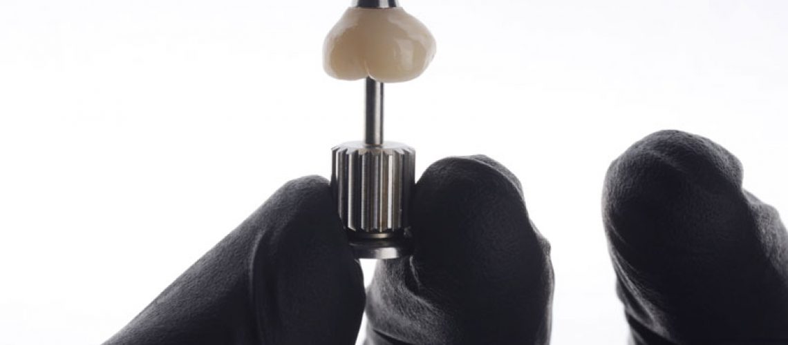 a single dental implant being held in with a crown on top of it