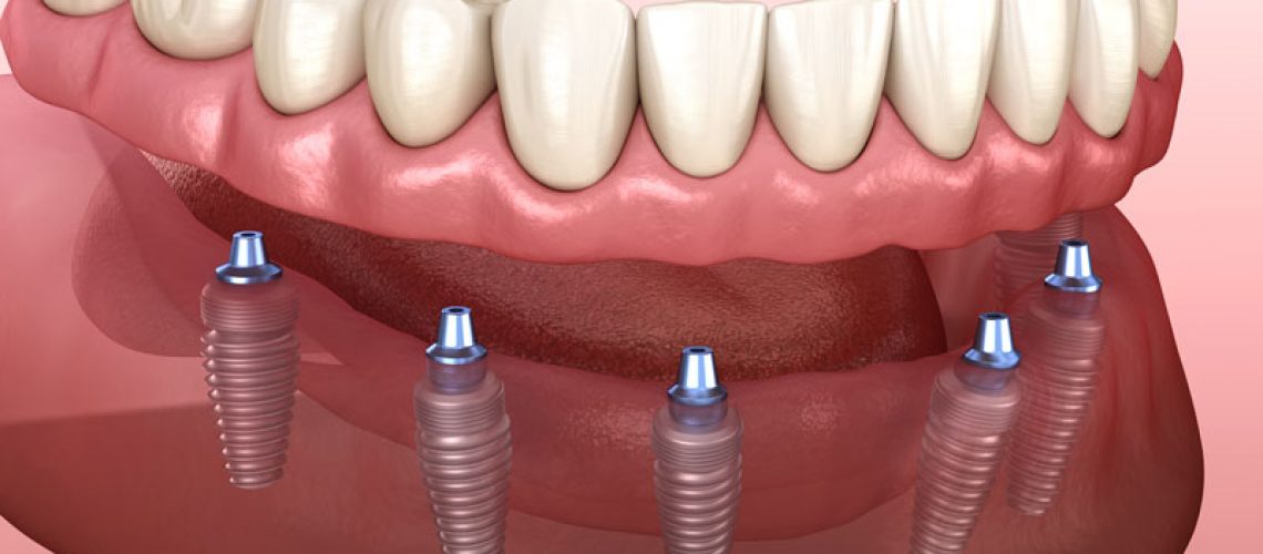denture supported implants with 6 implants supporting it