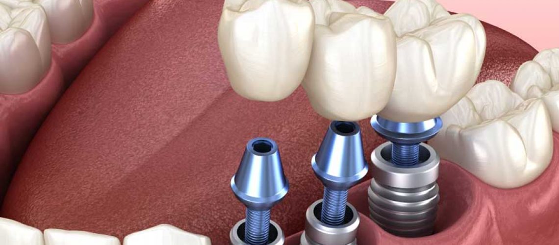 a diagram of three dental implants being placed