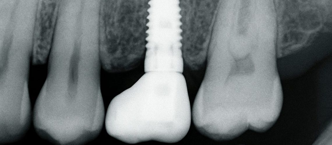 Close up X-Ray showcasing a dental implant seamlessly integrated into the jawbone, replacing a missing tooth. No text on image.