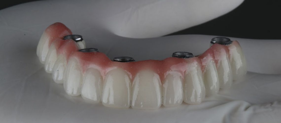 a full arch of teeth with holes for implants to be placed into it