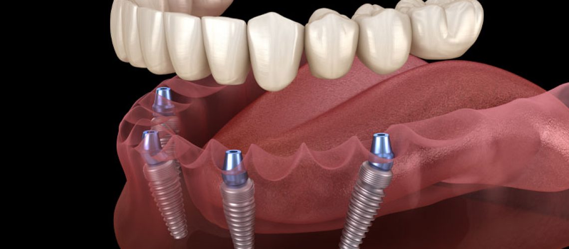 image of a lower arch full mouth dental implant model with four dental implants transparently embedded in the gums with the dental prosthesis hovering above it.