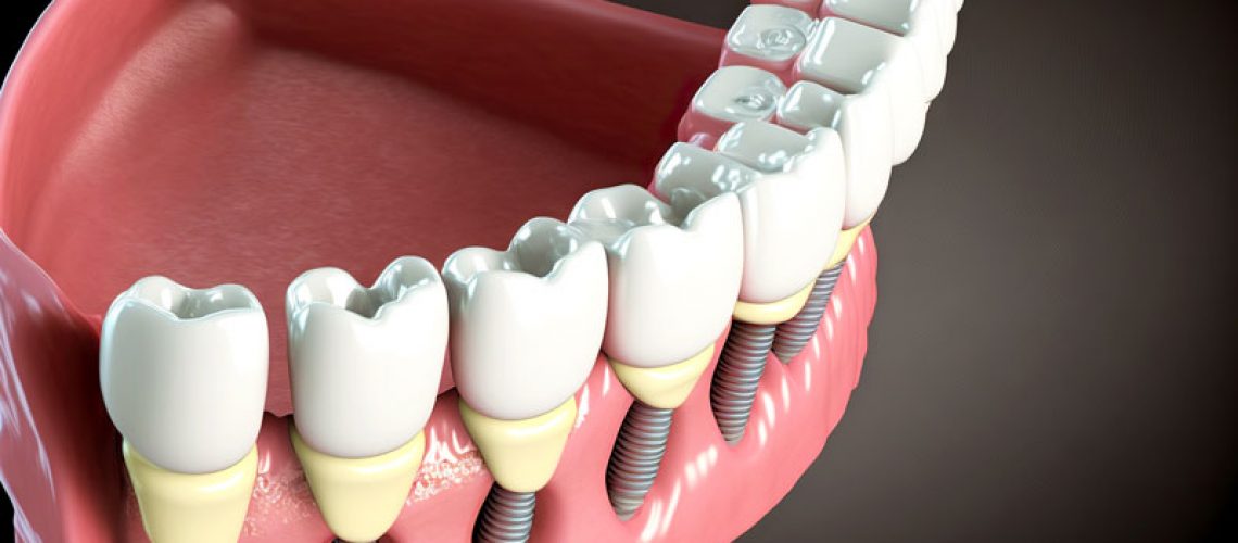 Close-up 3d model of a dental implant