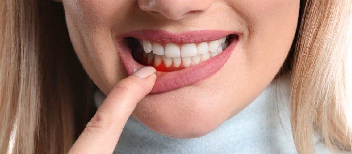 a woman with gum disease showing her inflamed gums