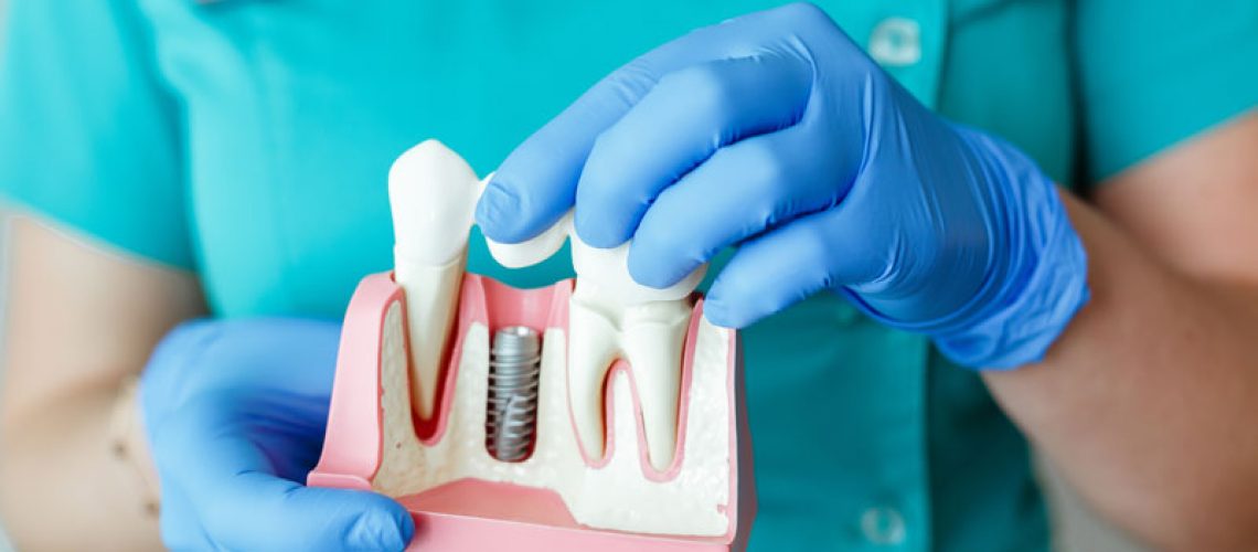 3D illustration of a single-tooth dental implant demonstrates each procedure component—implant, abutment, and crown- separately.