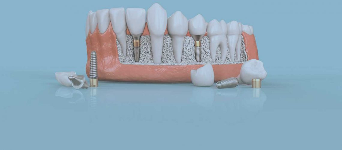 illustration of placed dental implants