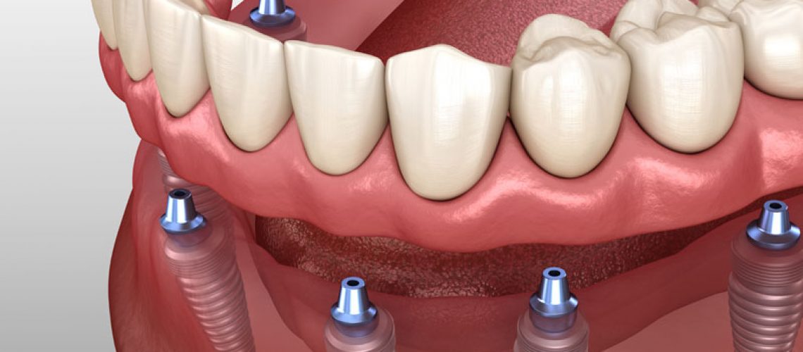 a digital model of a lower arch after an implant supported denture procedure.