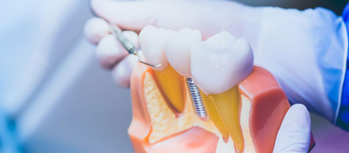 Image of a doctor holding a dental implants model at an angle.