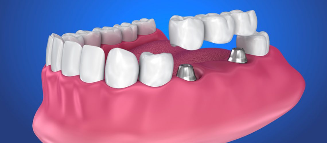 3d image of a dental implant bridge and a prosthesis jaw with a blue backdrop