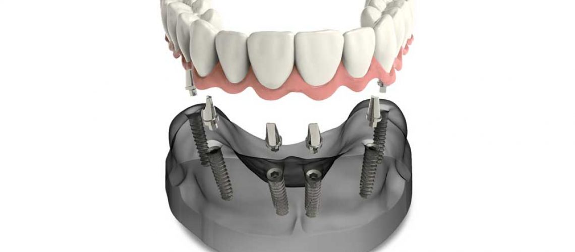model of full arch dental implants