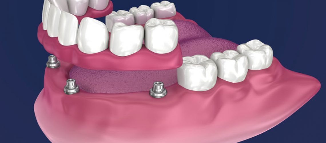 Graphic Of A Partial Denture Being Mounted On Dental Implants