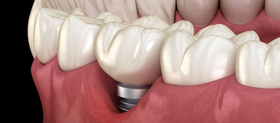 Receded Dental Implant
