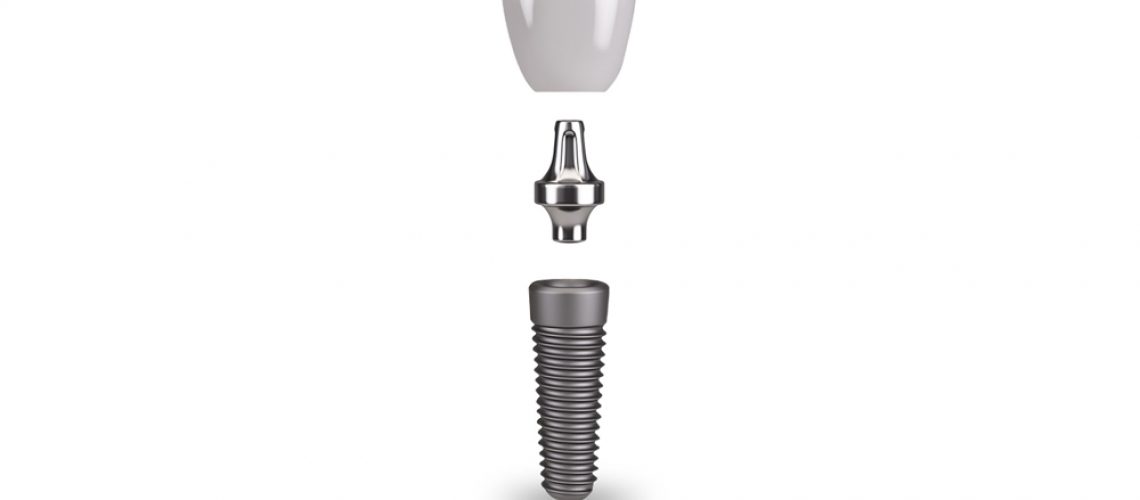 the three components of a dental implant